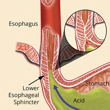 Image showing acid reflux